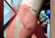 Ομόνοια: Νεαρός έβαλε το πίτμπουλ του να επιτεθεί σε 30χρονο για να τον ληστέψει – «Με έριξε κάτω και το σκυλί με δάγκωνε»