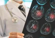 Φάρμακο βοηθά στην μείωση των επαναλαμβανόμενων εγκεφαλικών επεισοδίων – Ο ρόλος της Ελλάδας στη μελέτη