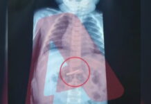 Στο νοσοκομείο 3χρονο αγόρι που κατάπιε ξυραφάκι: Υποβλήθηκε σε χειρουργική επέμβαση και αναρρώνει