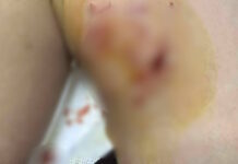 Κρήτη: Άγρια επίθεση σκύλου σε 12χρονο στη Μεσαρά – Τον τραυμάτισε σοβαρά σε πολλά σημεία του σώματος