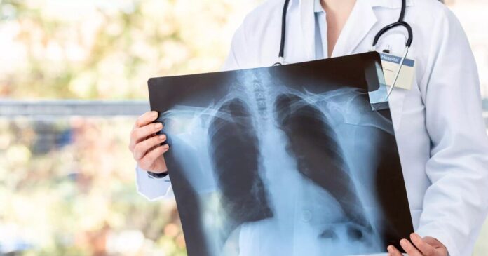 istock-1390646222-karkinos-pneumonas-1200x630.jpg
