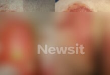Θεσσαλονίκη: 52χρονη υπέστη χημικά εγκαύματα στα γεννητικά όργανα μετά από εξέταση – «Της έριξαν οξύ και της έλεγαν ότι έχει αλλεργία»